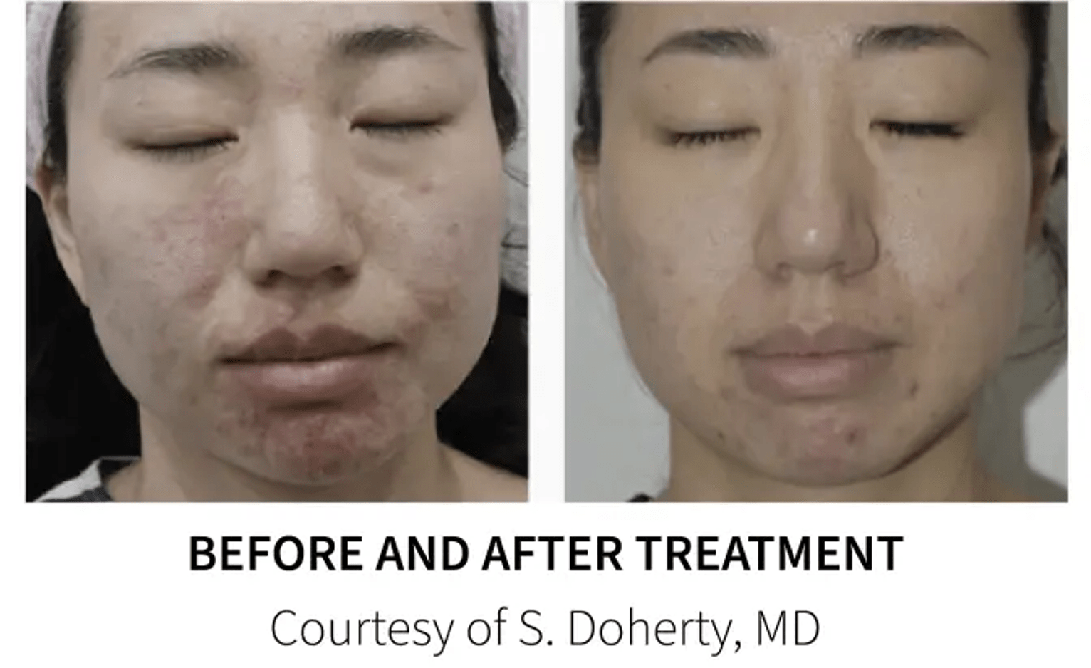 Potenza Microneedling Treatment woman before and after