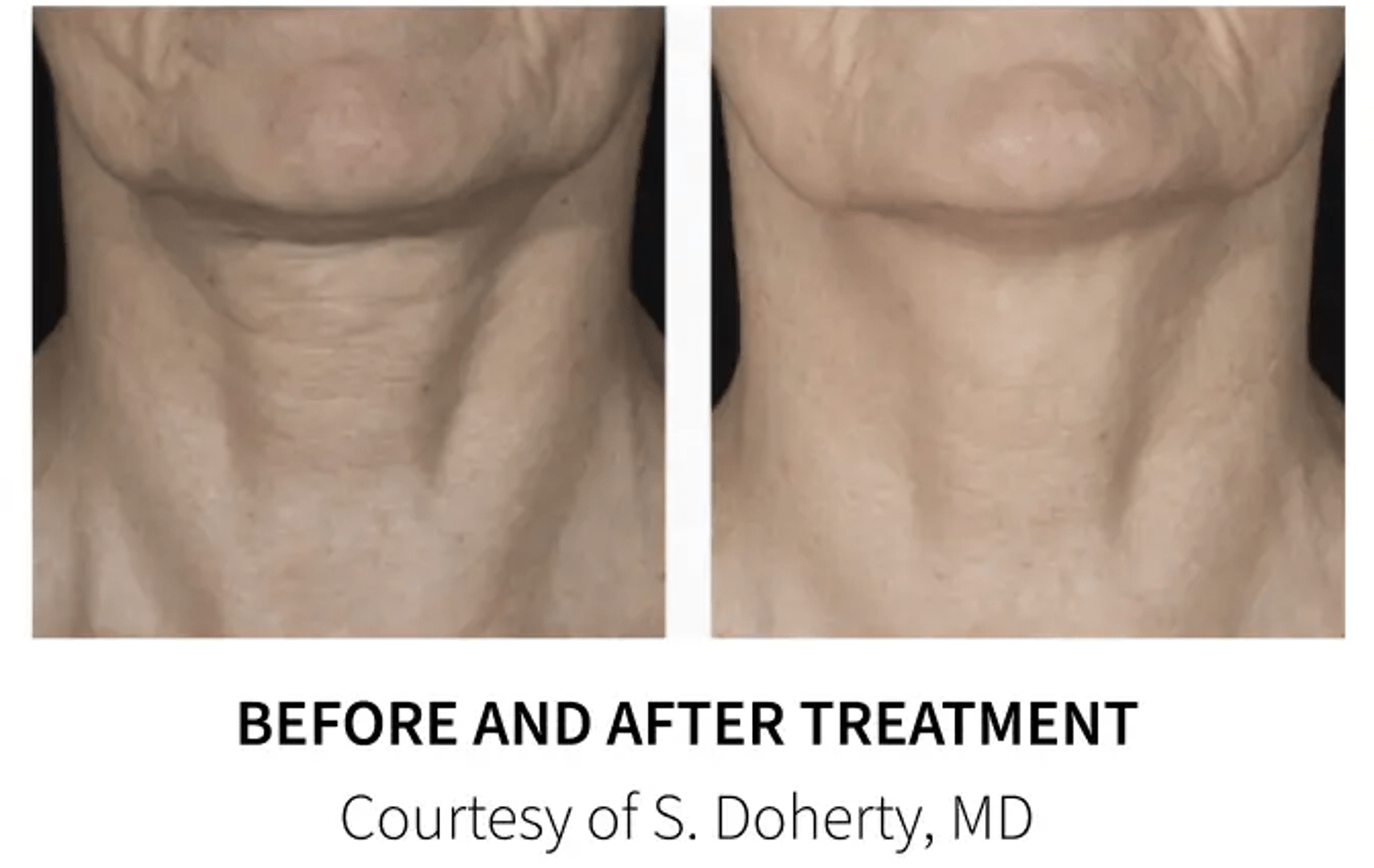 neckline before and after the eye wearhouse microneedling