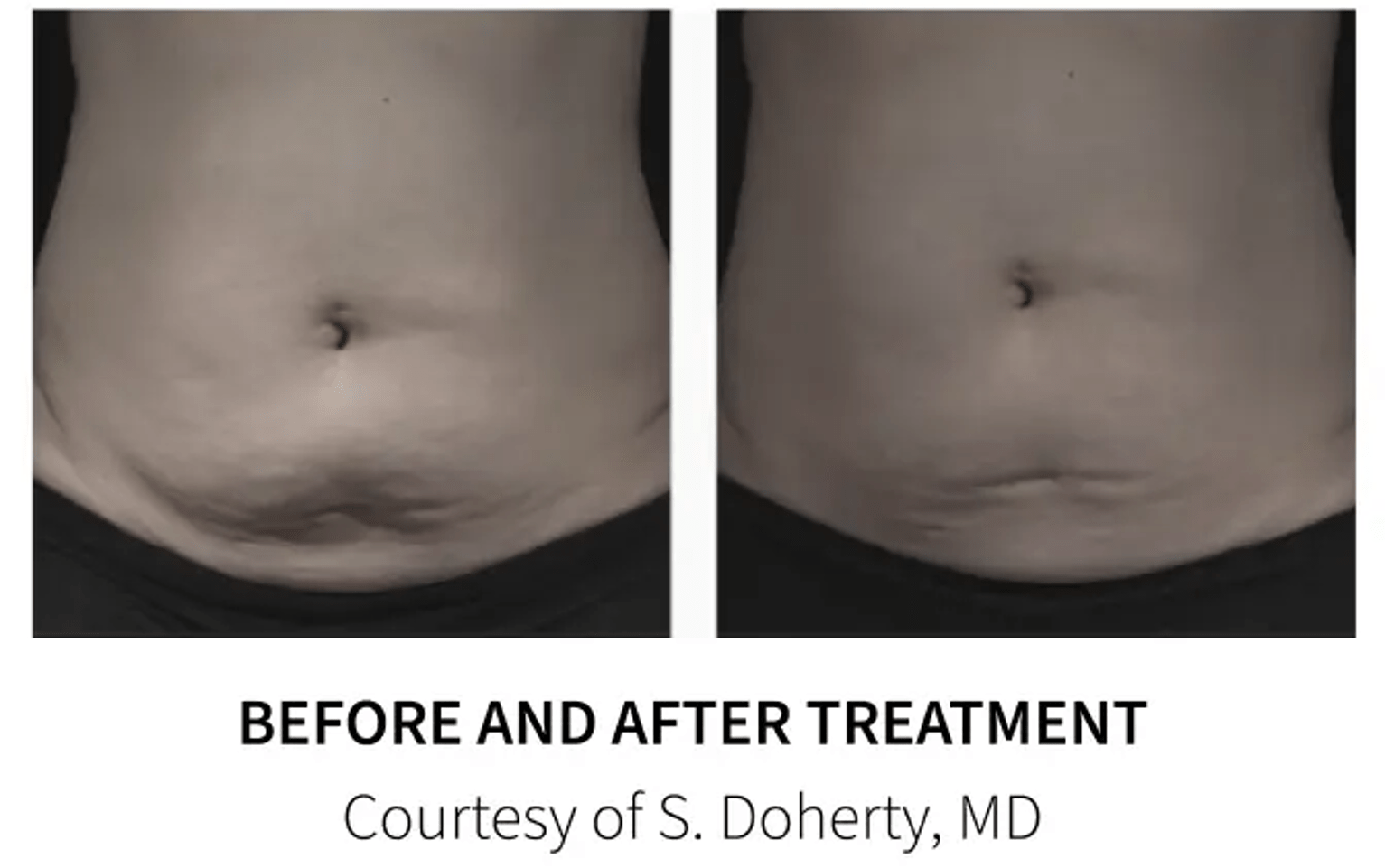 before and after of a stomach microneedling
