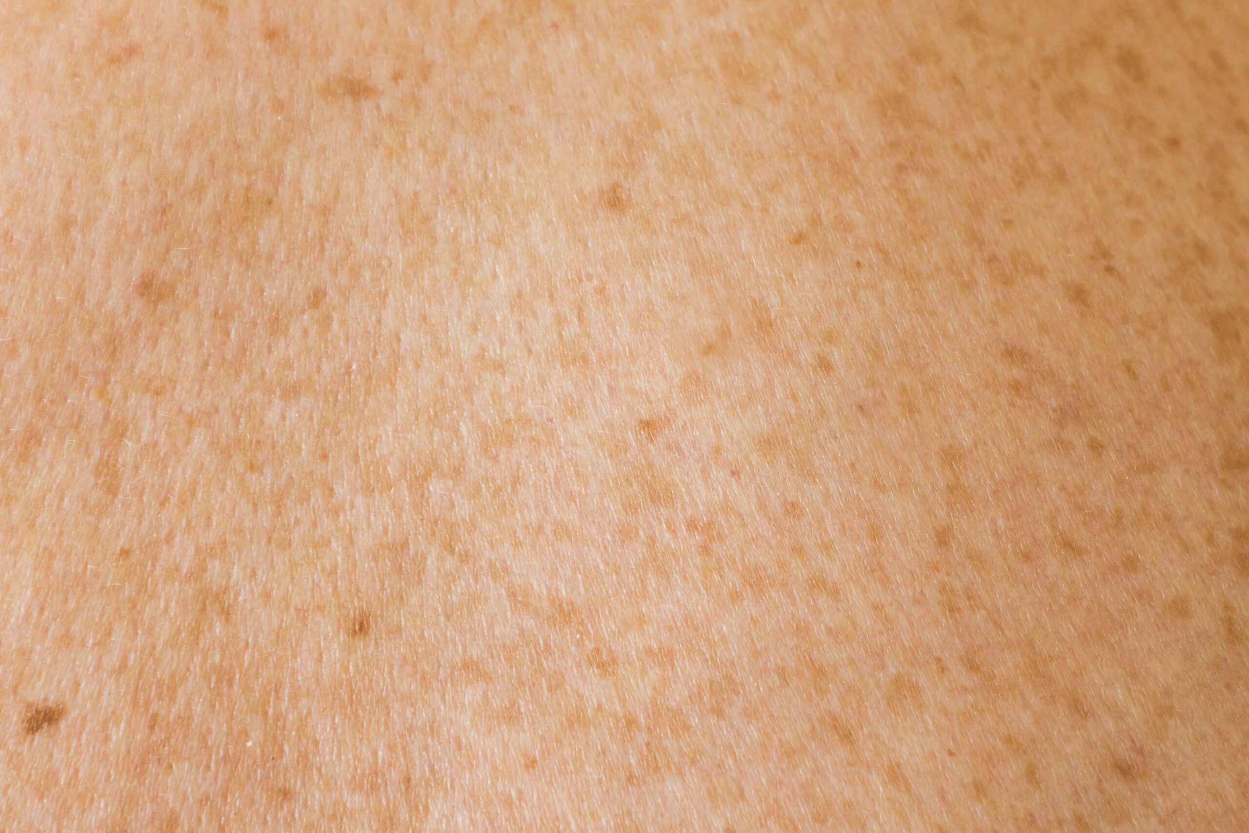 Featured image for “The Most Common Types of Hyperpigmentation and How to Treat Them”